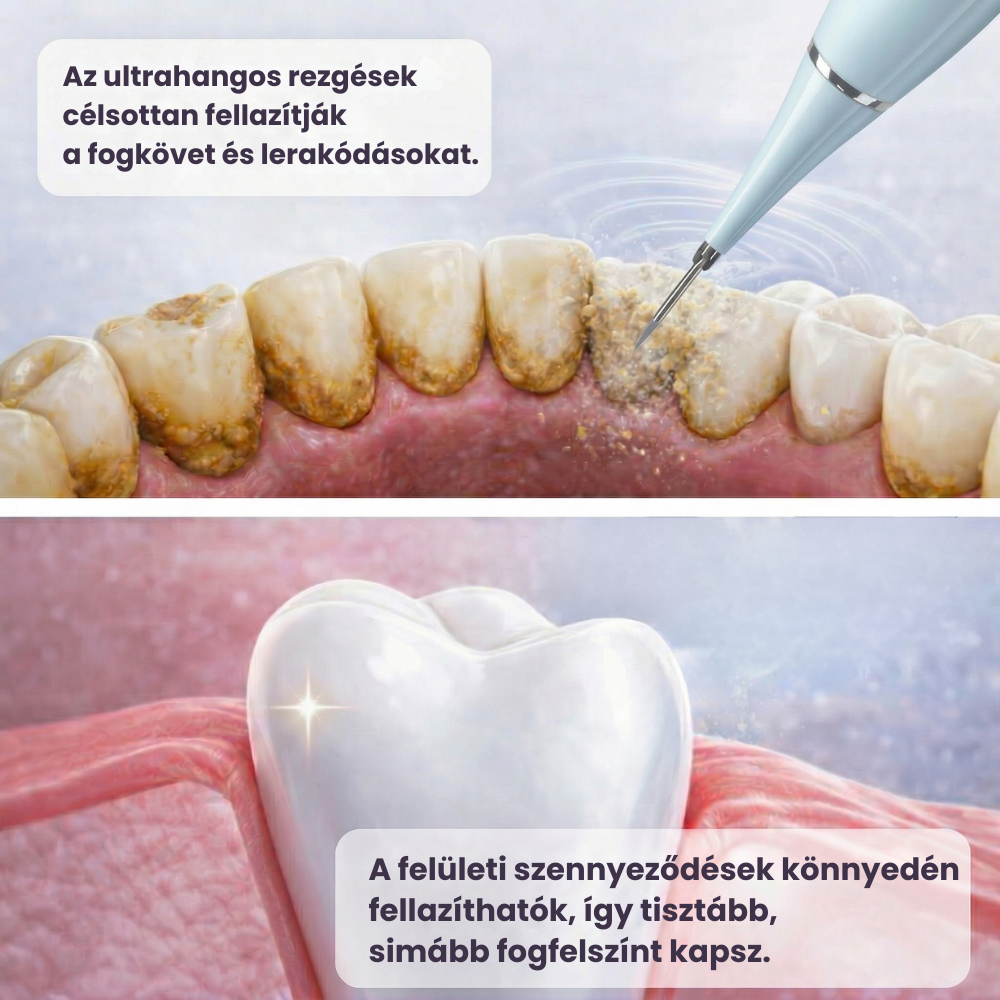 Zaluna ultrahangos fogtisztító